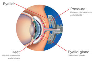 lipiflow-cross-section