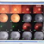 Cataract Surgery NYC | Eye Specialist | Dr. Schottenstein