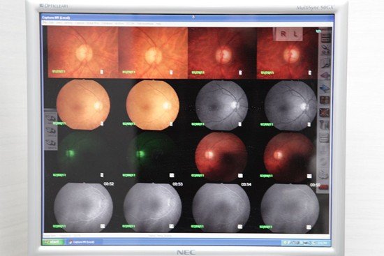 Cataract Surgery NYC | Eye Specialist | Dr. Schottenstein